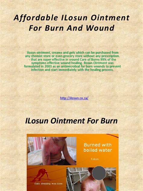 ilosun ointment where to buy|Ilosun Burn.